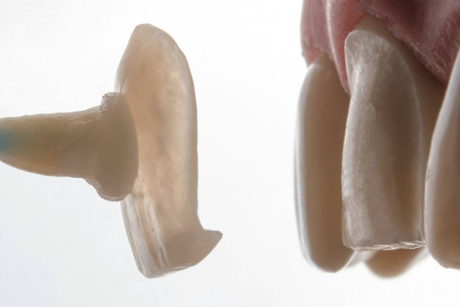 Not All Veneers Are the Same: Let’s Find Your Perfect Match!