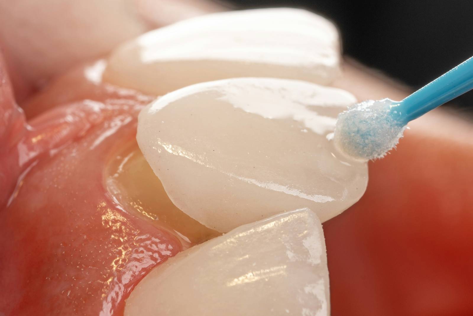 Porcelain or Composite? Finding the Best Veneer for You