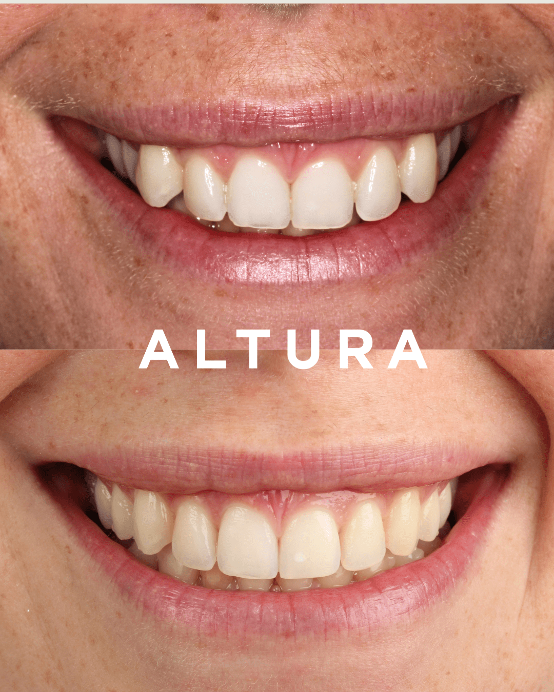 A-OT-TEETH-KC (JMIU)