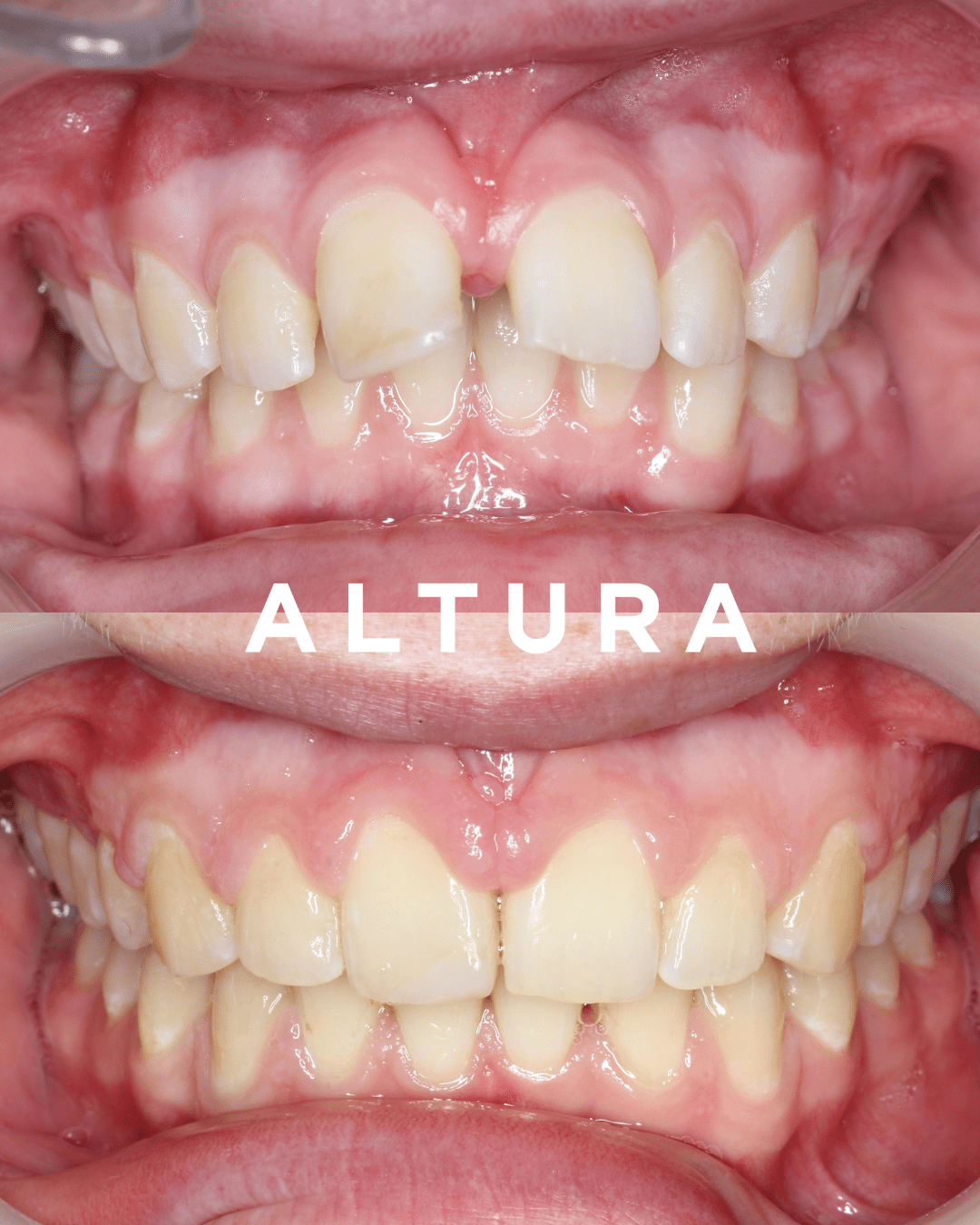 A-OT-TEETH-MP (JMIU)