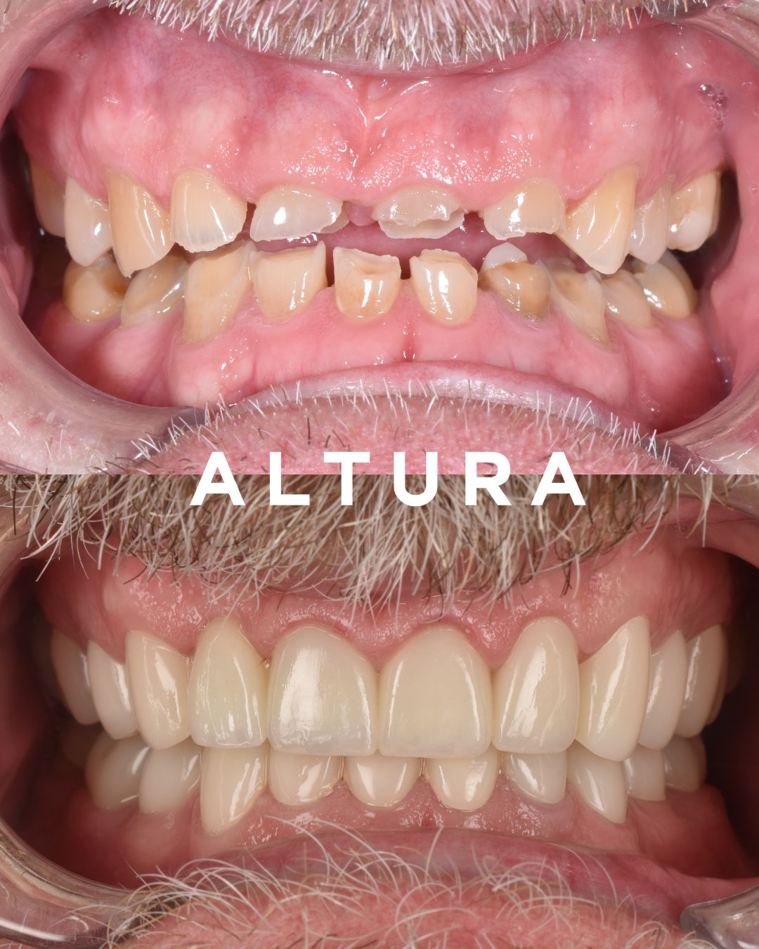 C-CR-AC-TEETH-AP-01