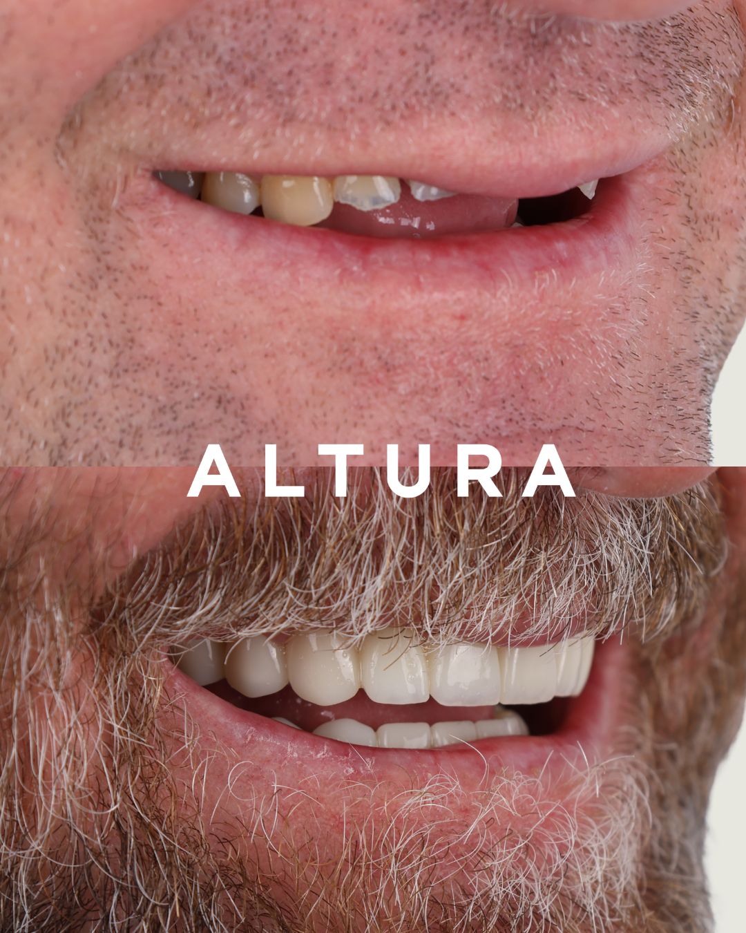 C-CR-AC-TEETH-AP-03