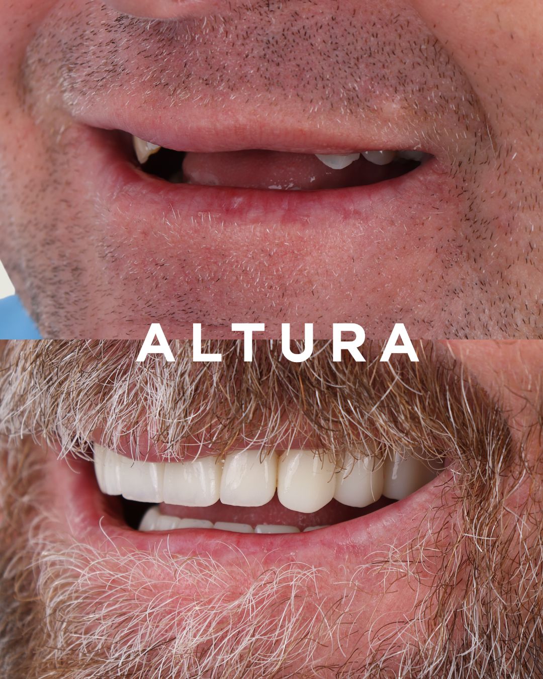 C-CR-AC-TEETH-AP-04