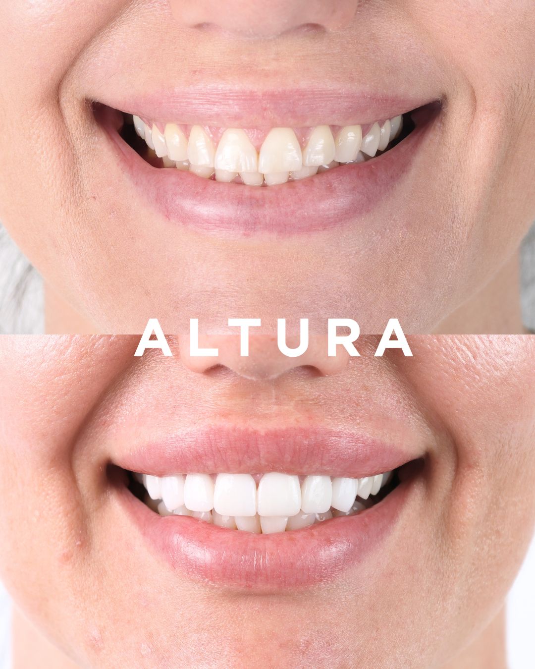 C-CR-AC-TEETH-BA-1