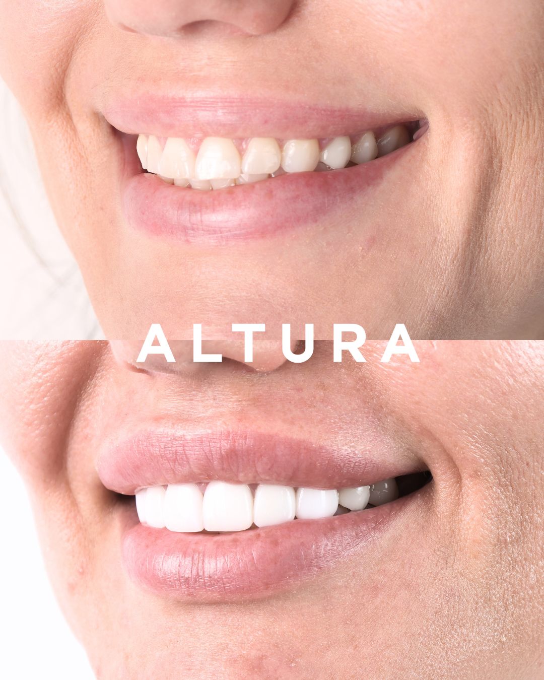 C-CR-AC-TEETH-BA-2