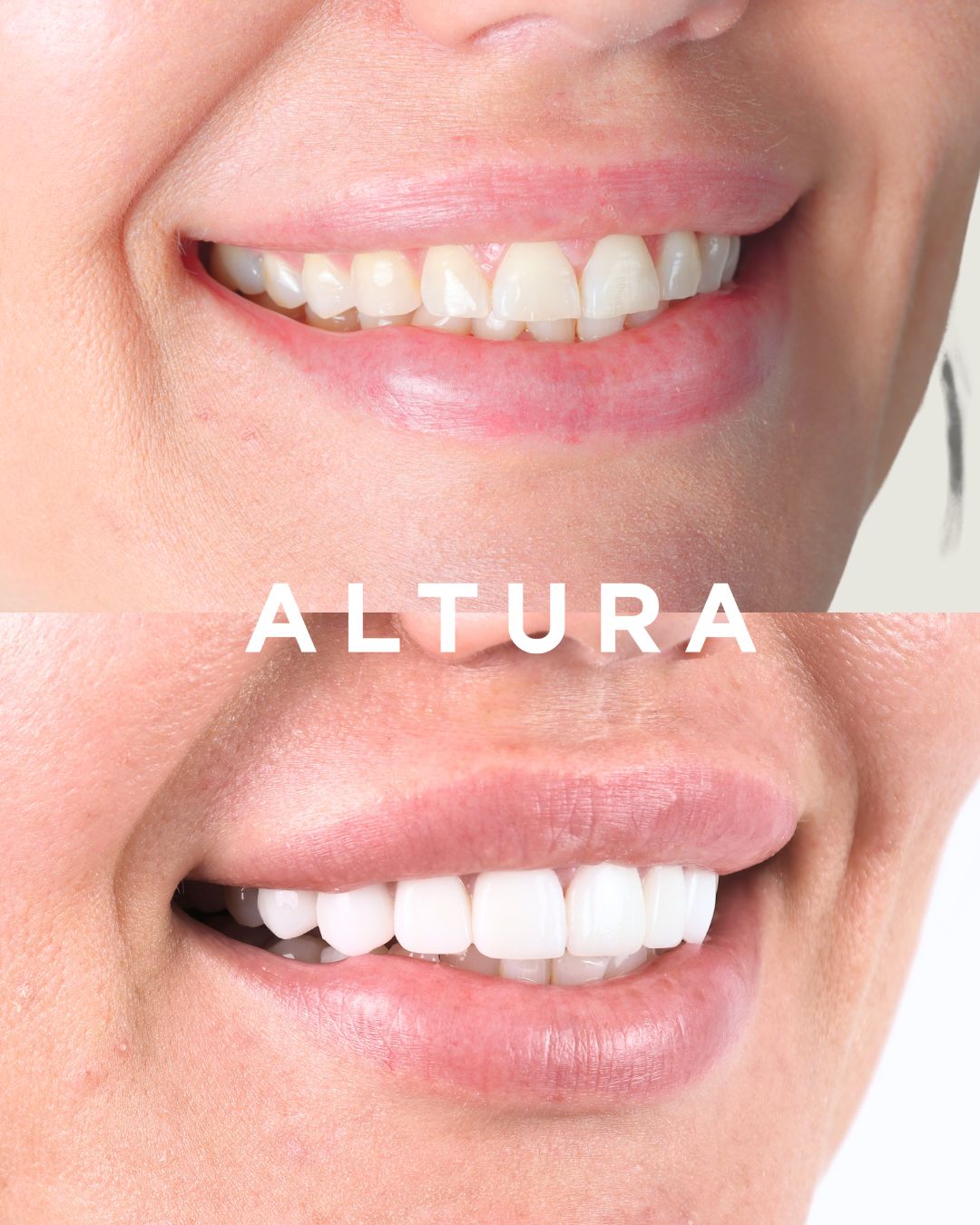 C-CR-AC-TEETH-BA-3