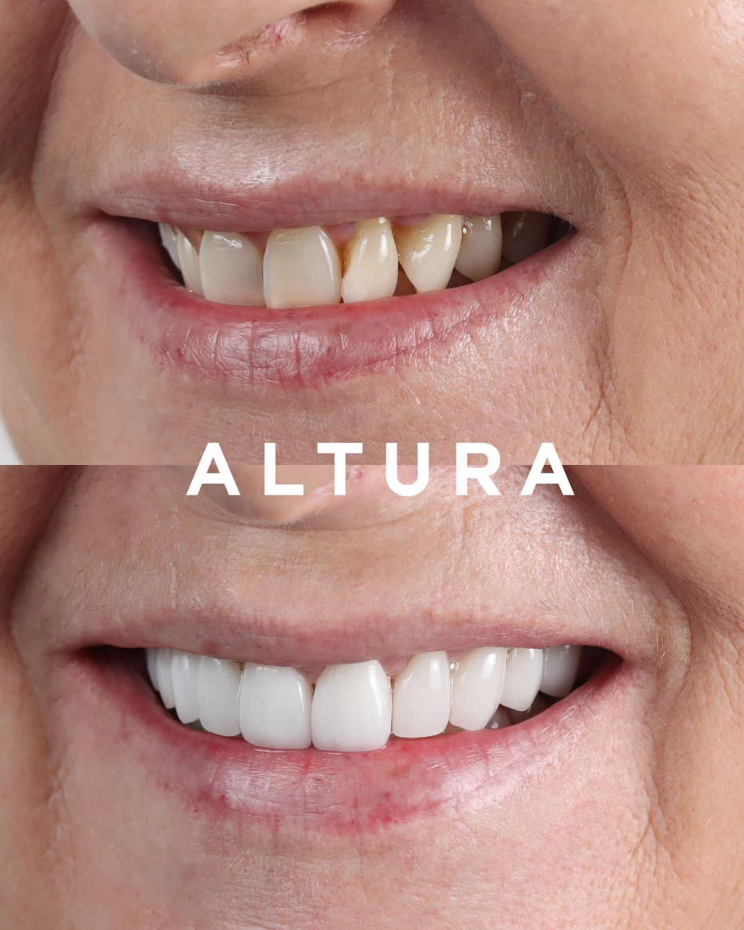 C-CR-AC-TEETH-LT-02