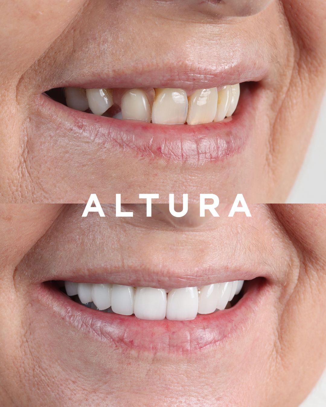 C-CR-AC-TEETH-LT-03