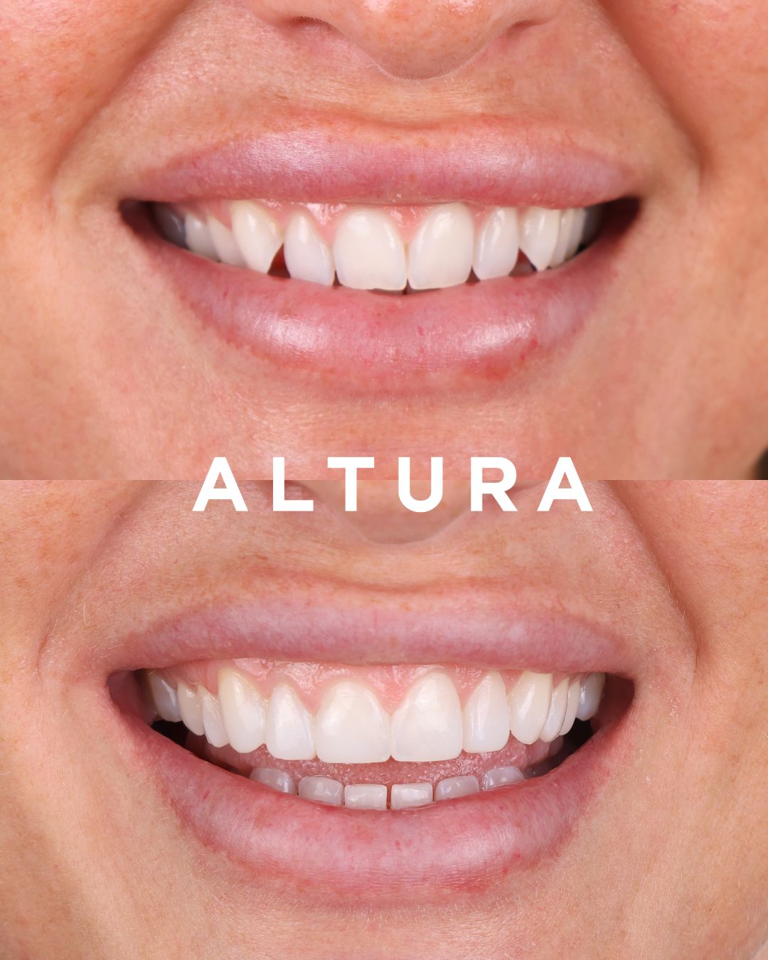 C-CV-EB-AC-TEETH-RB-1