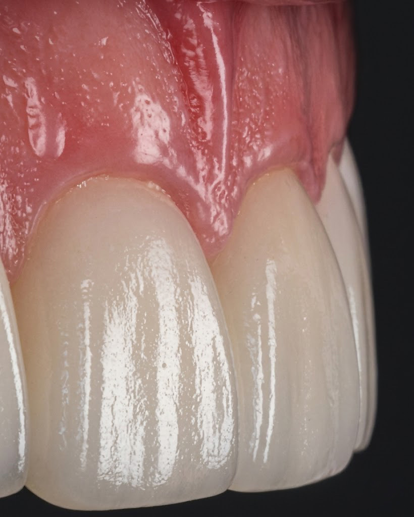 Gum Disease