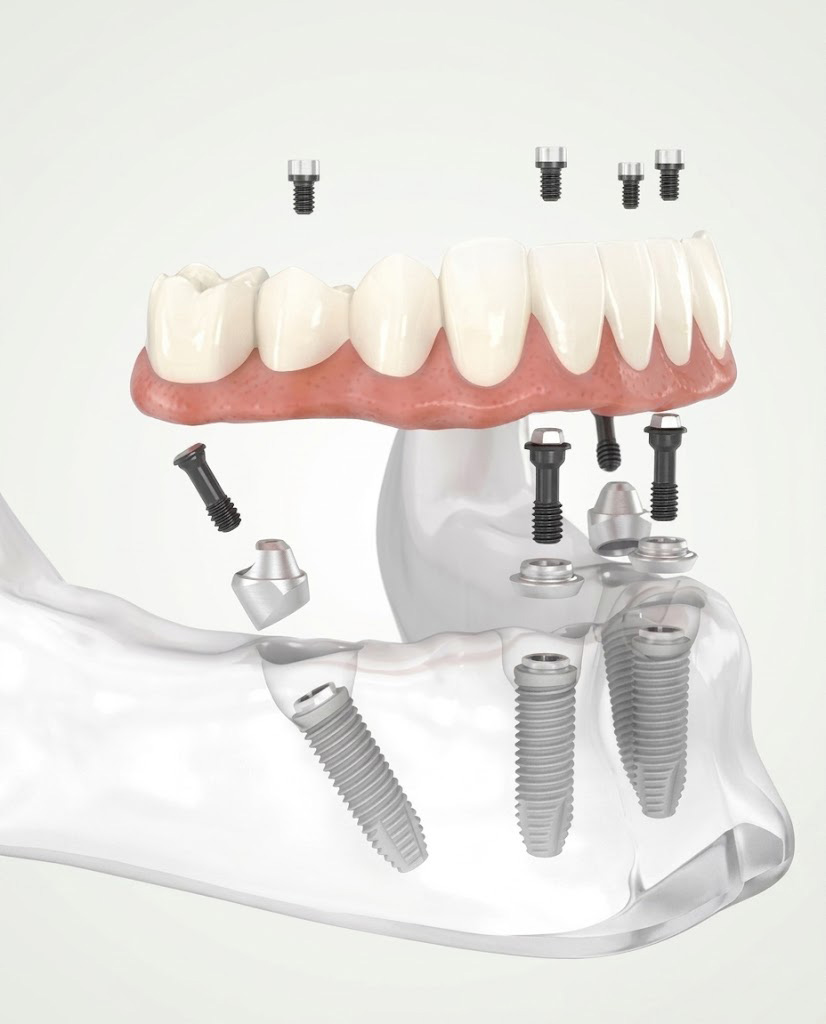 Multiple Teeth Implants