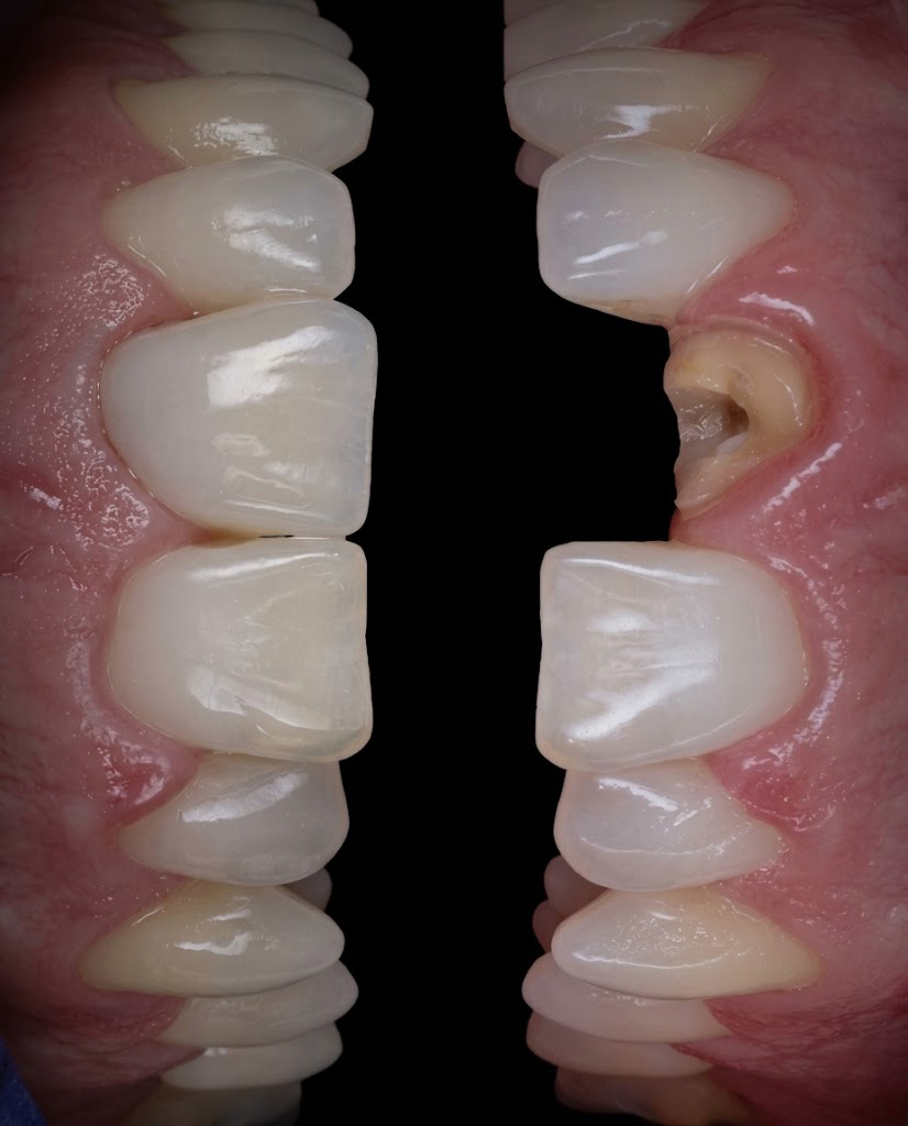 Single Implants