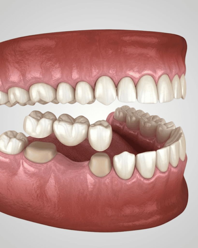 Dental Crowns and Bridges 1