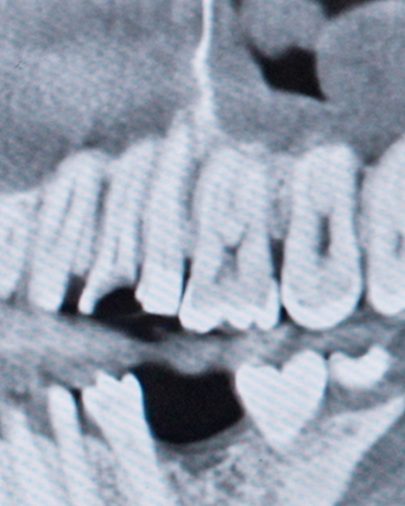 Wisdom Tooth