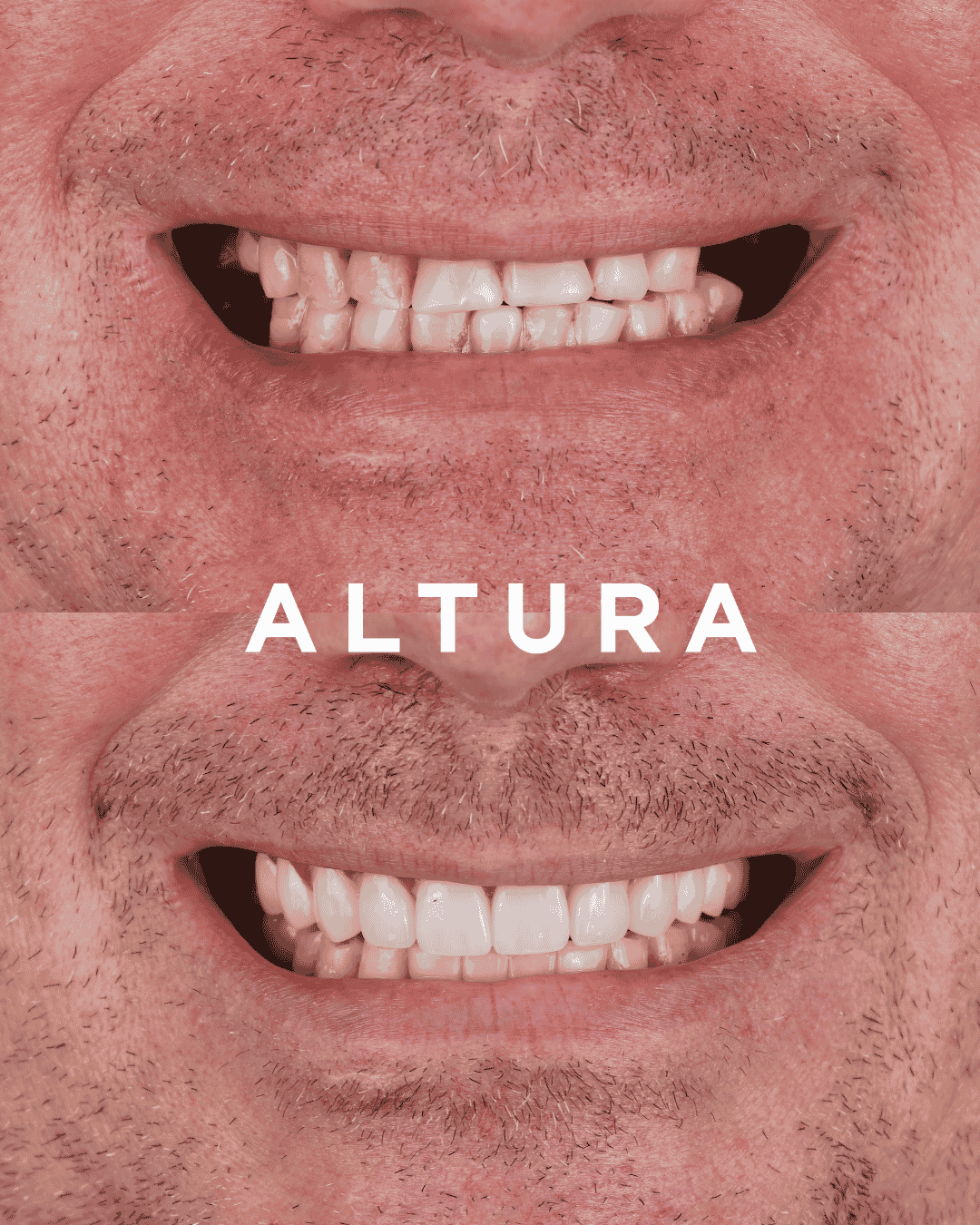 C-CR-AC-TEETH-AK1