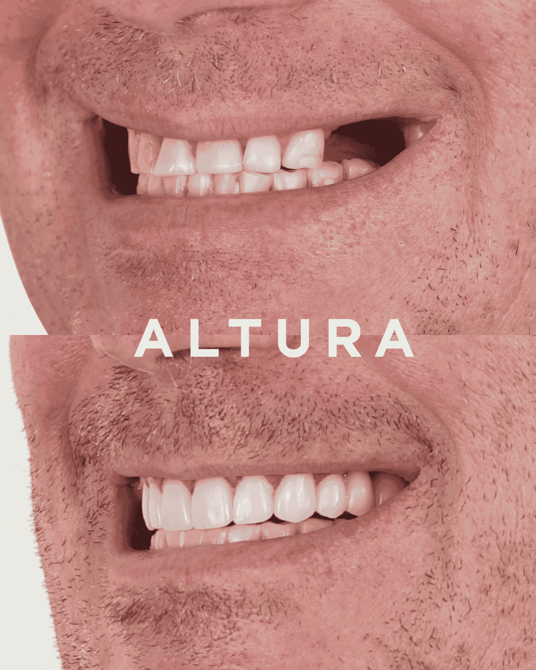 C-CR-AC-TEETH-AK2