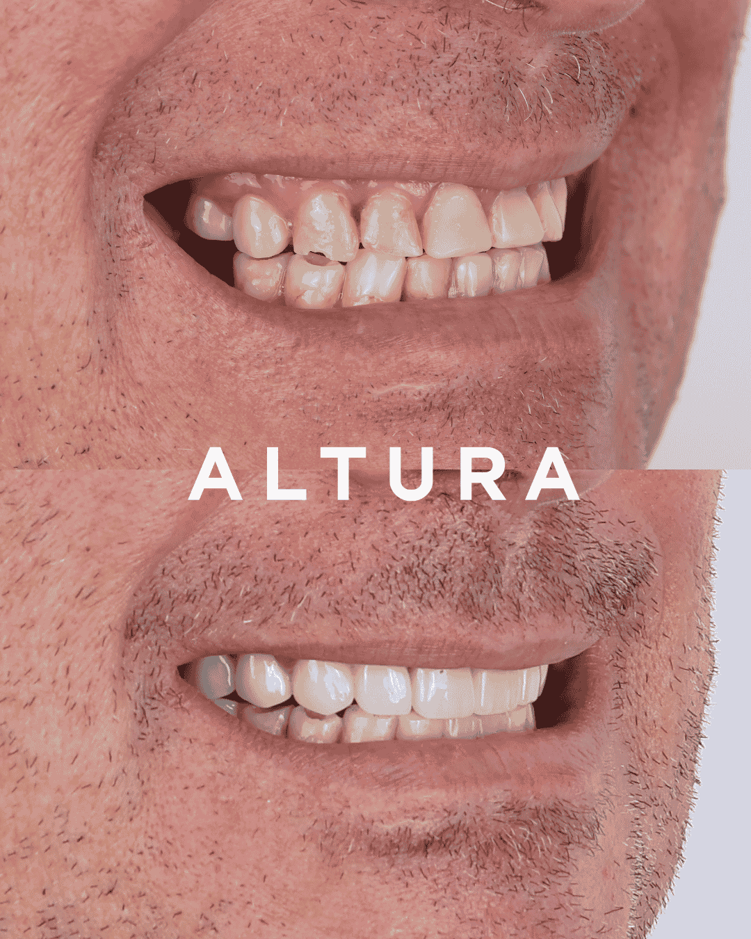 C-CR-AC-TEETH-AK3