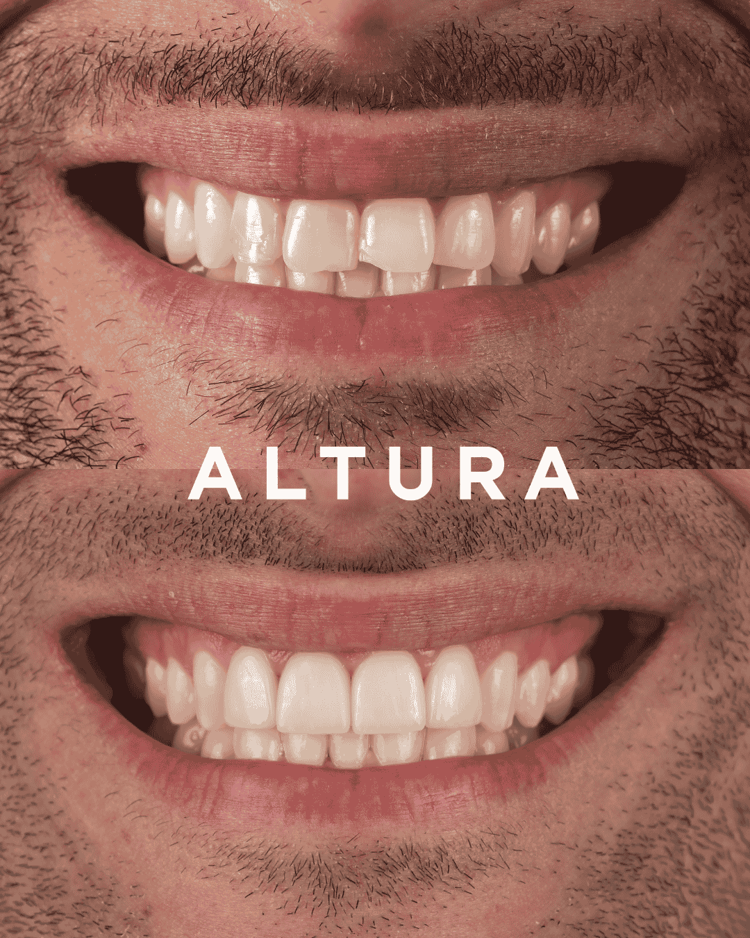 C-CR-AC-TEETH-JT1
