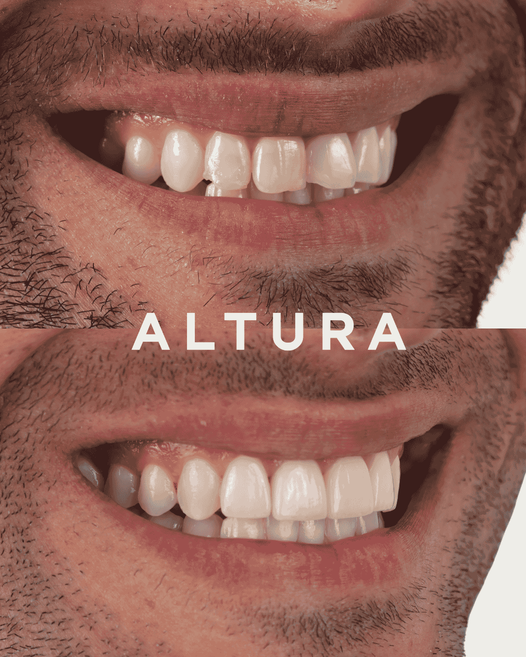 C-CR-AC-TEETH-JT3