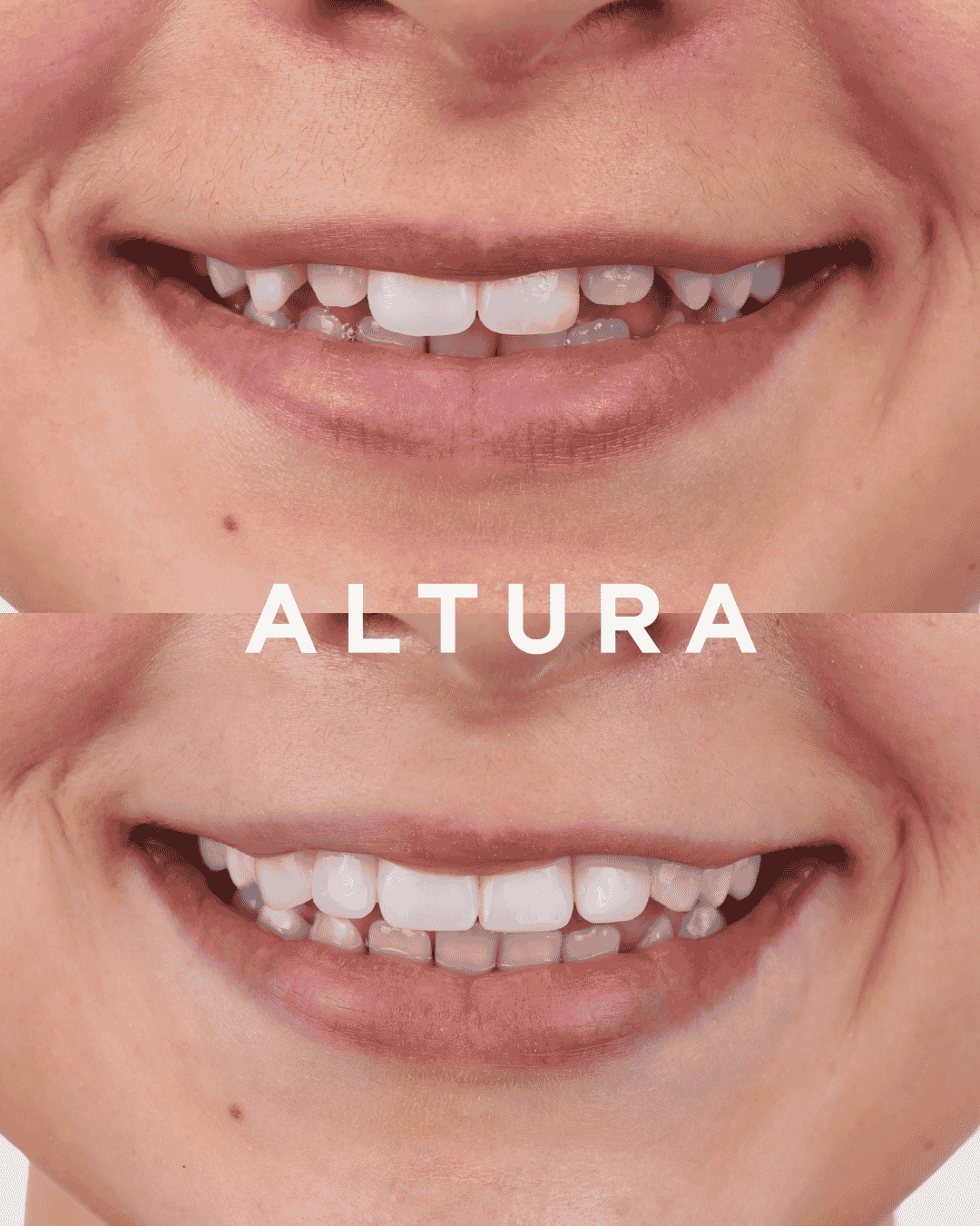 C-EB-CV-AC-TEETH-RJ1