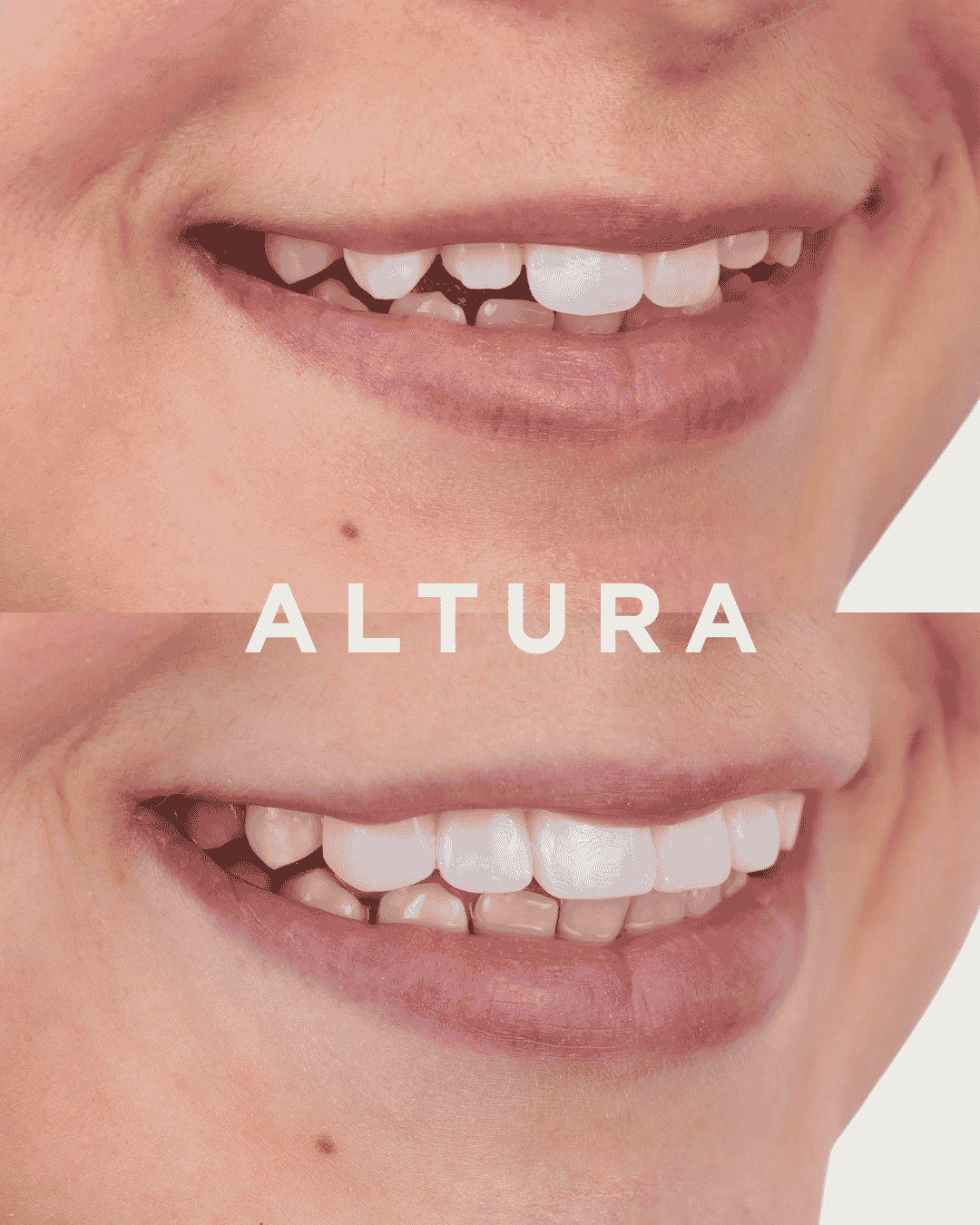 C-EB-CV-AC-TEETH-RJ3