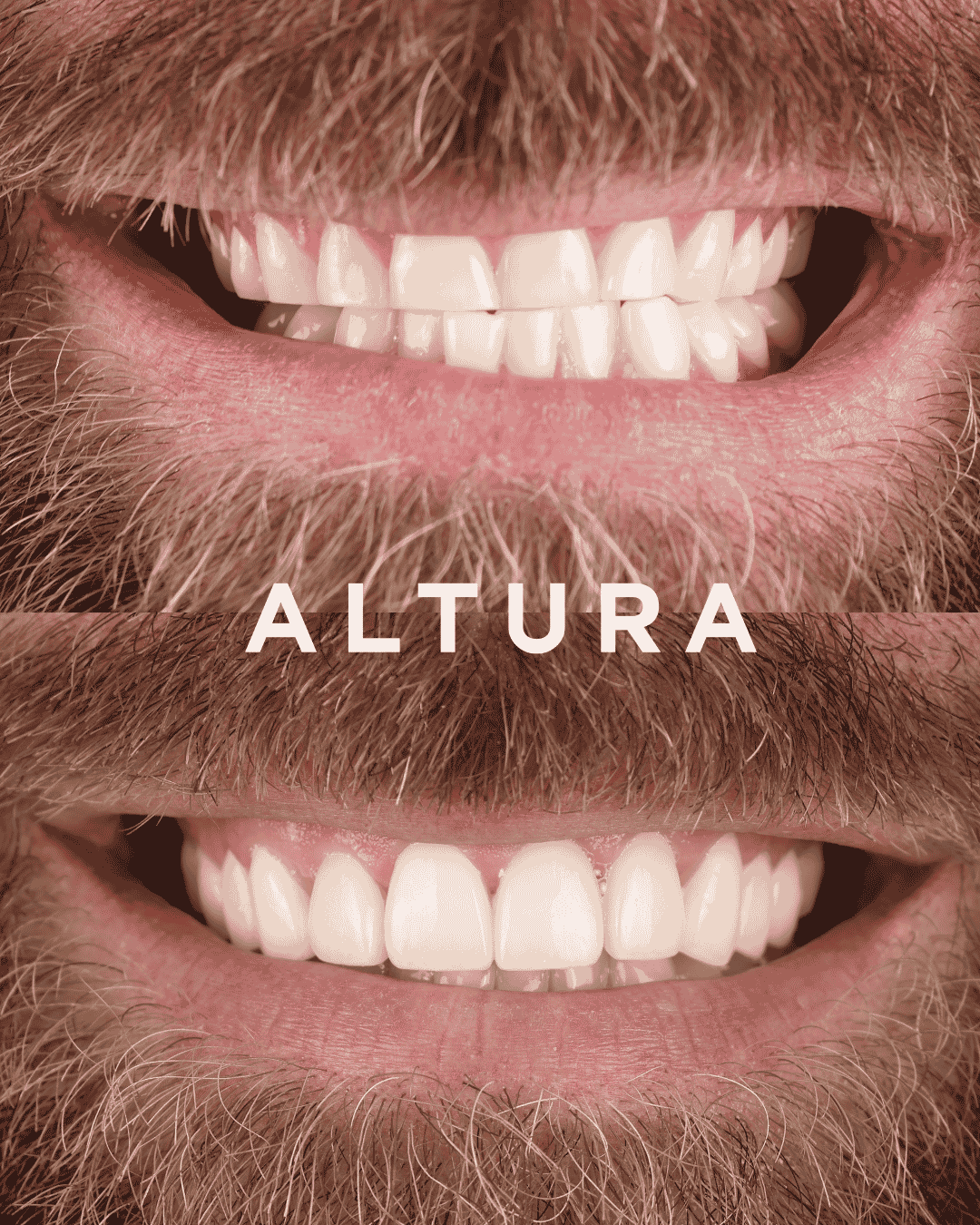 C-PV-AC-TEETH-DR1