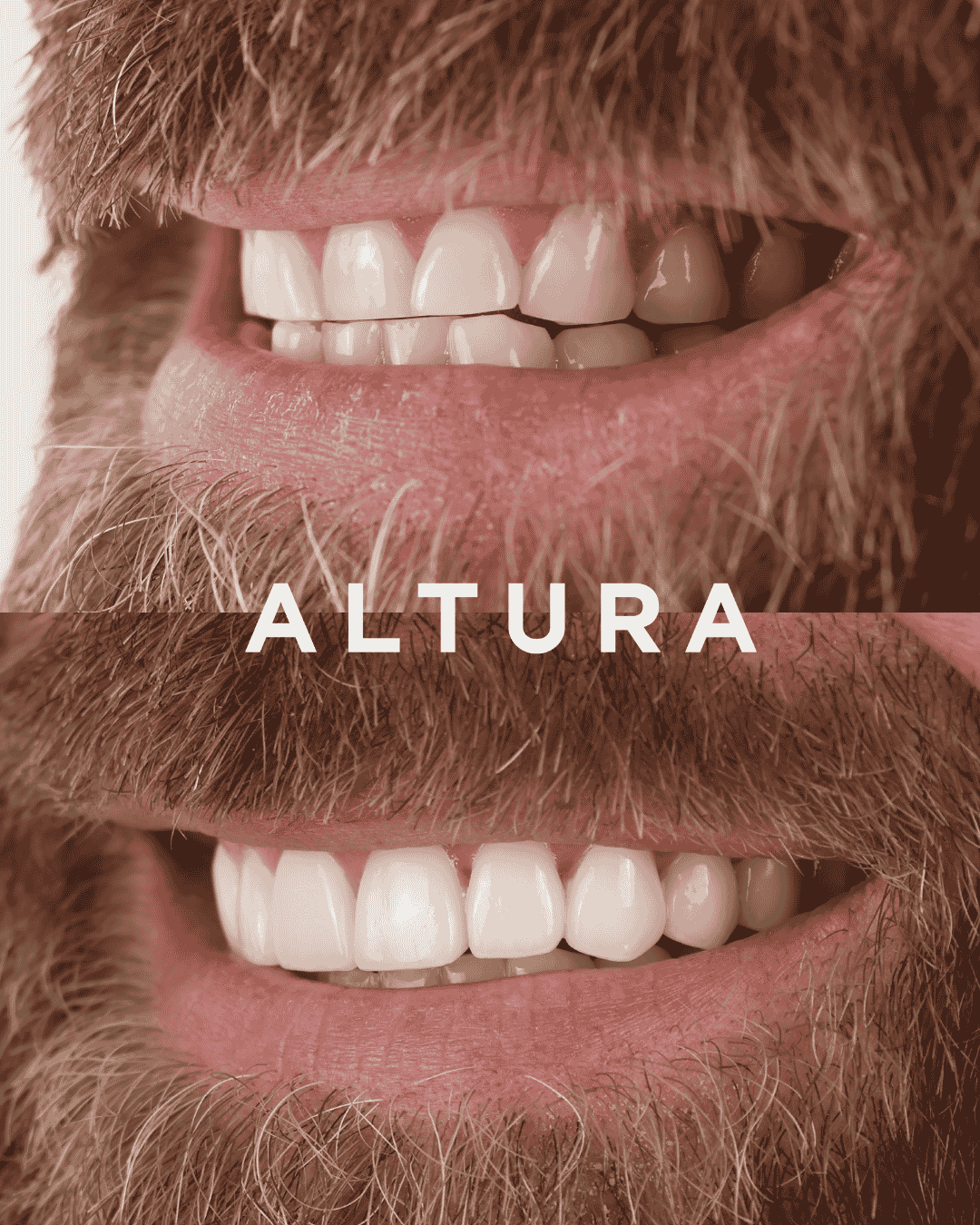 C-PV-AC-TEETH-DR2