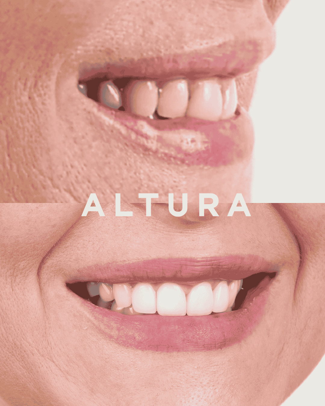 C-PV-AC-TEETH-KM3