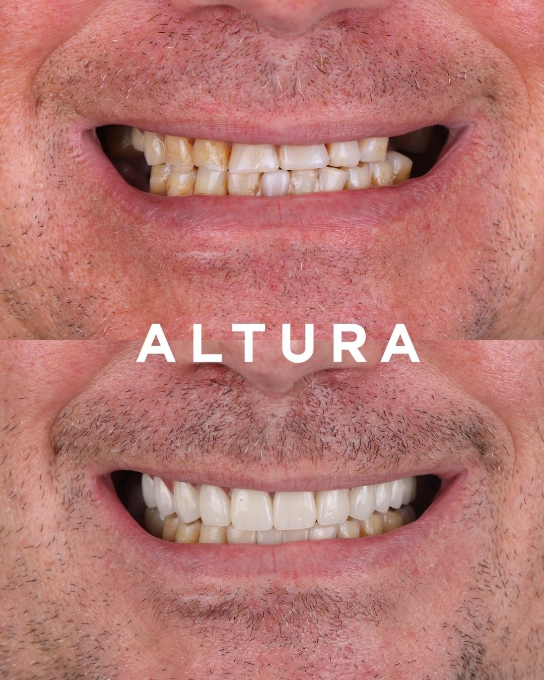 C-CR-AC-TEETH-AK-1