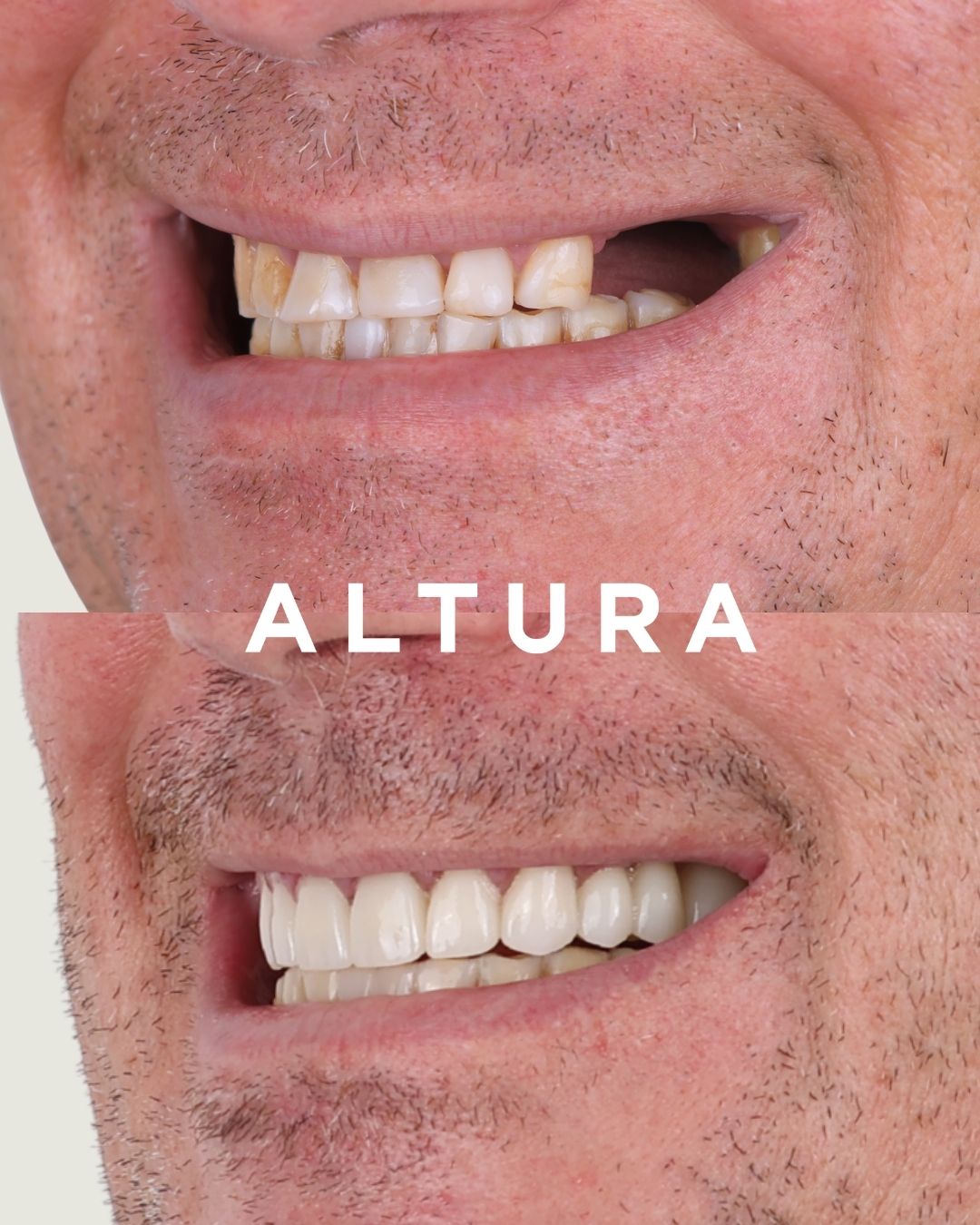 C-CR-AC-TEETH-AK-2
