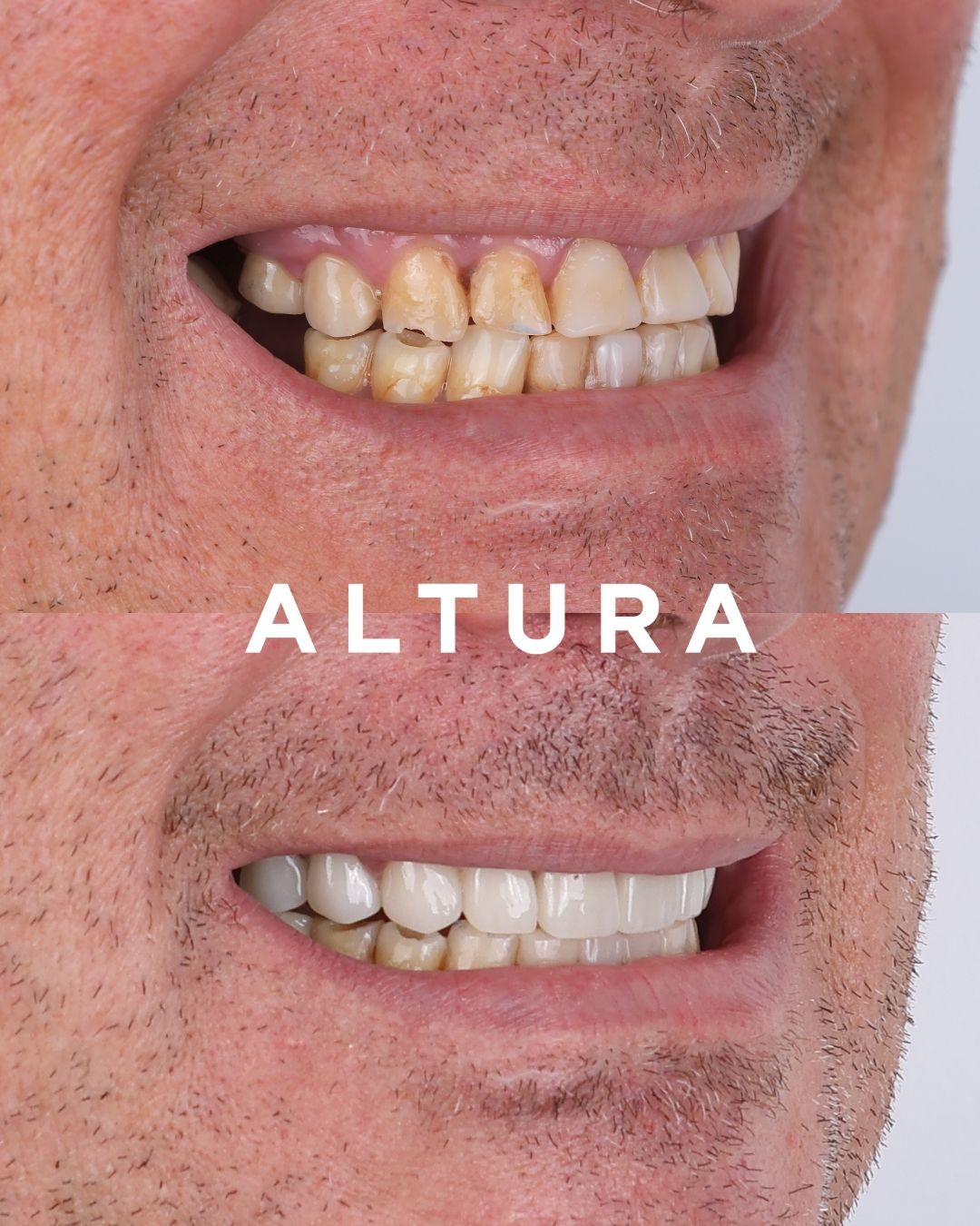 C-CR-AC-TEETH-AK-3