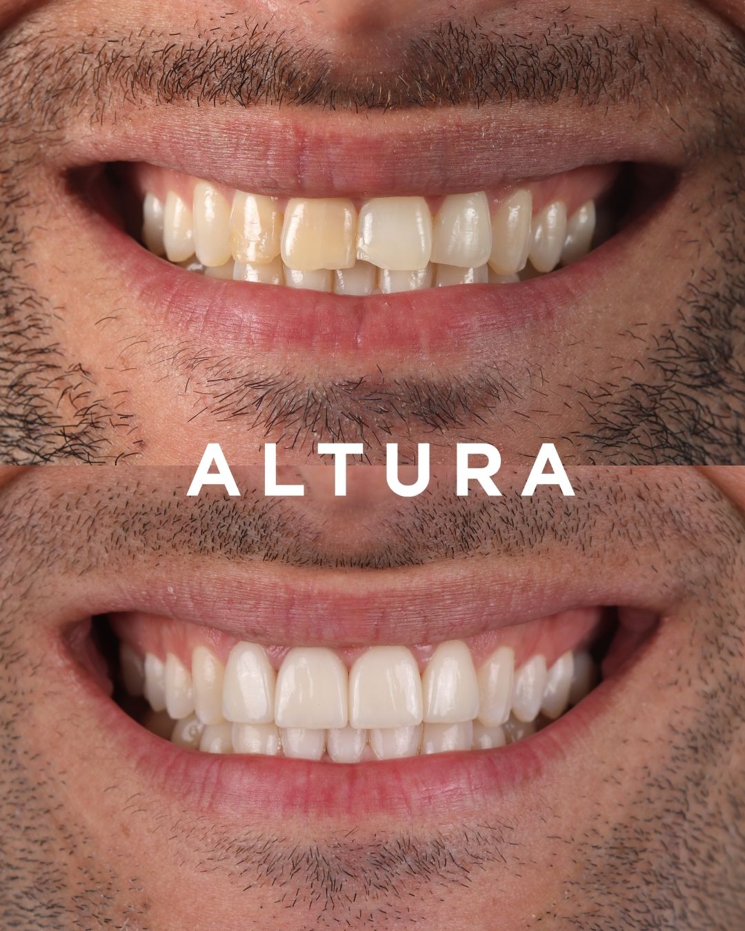 C-CR-AC-TEETH-JT-1