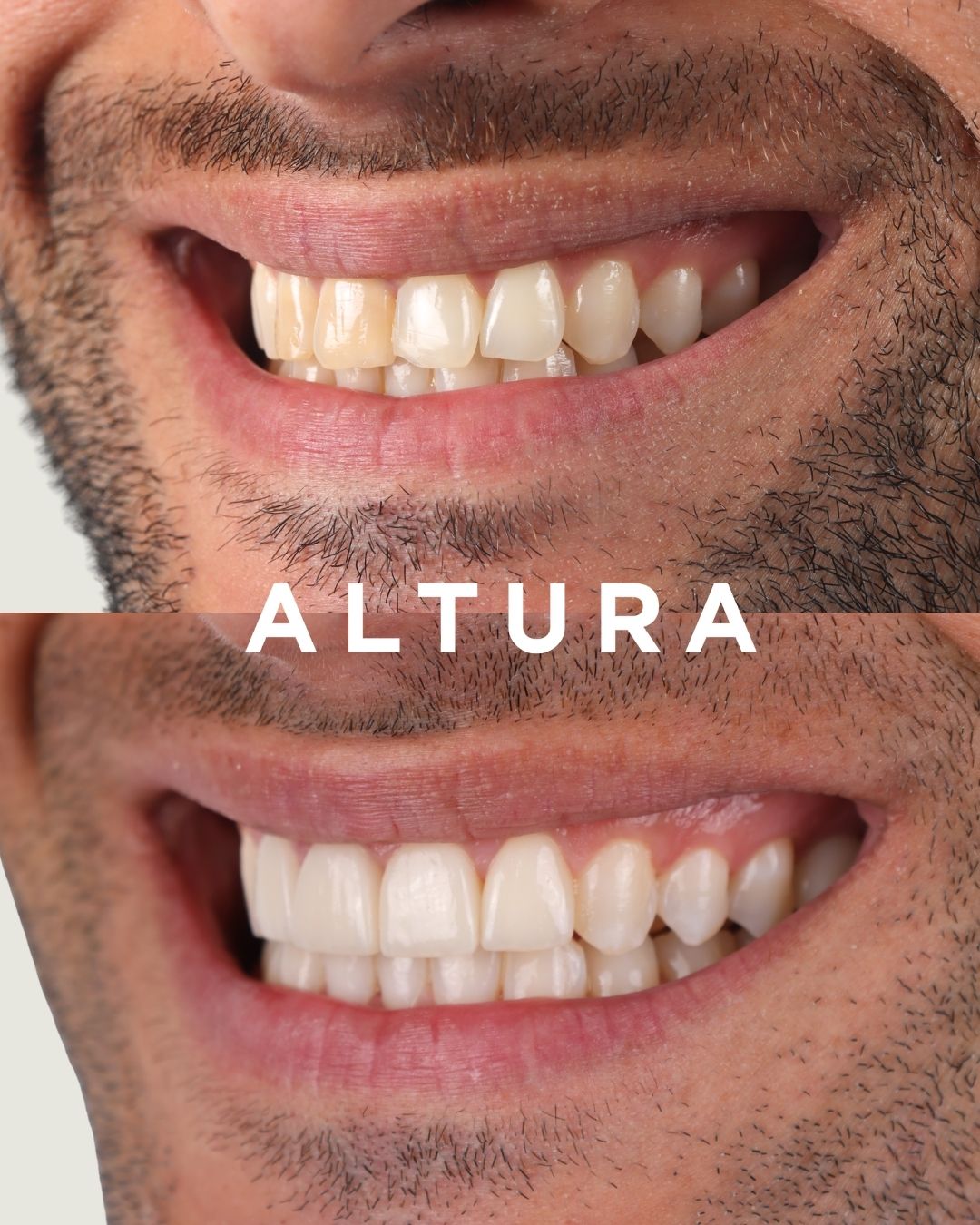 C-CR-AC-TEETH-JT-2