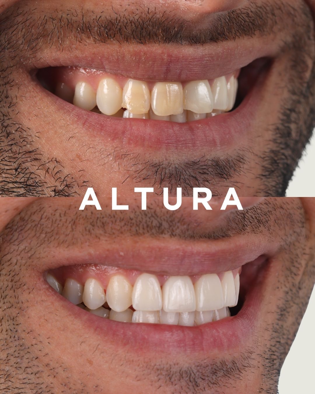 C-CR-AC-TEETH-JT-3