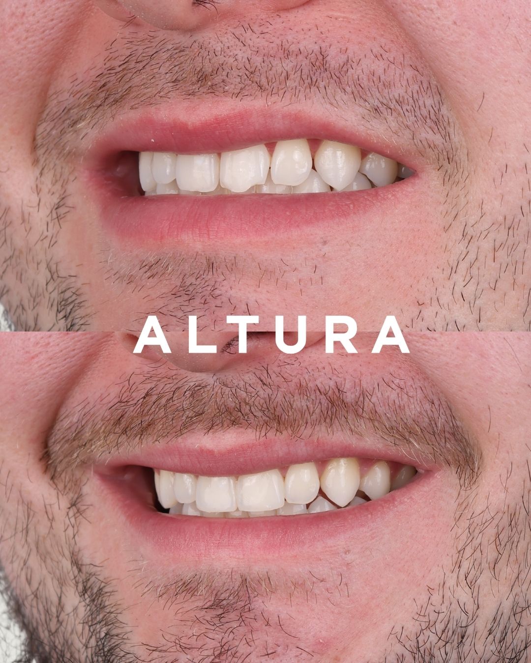 C-EB-AC-TEETH-AM-2