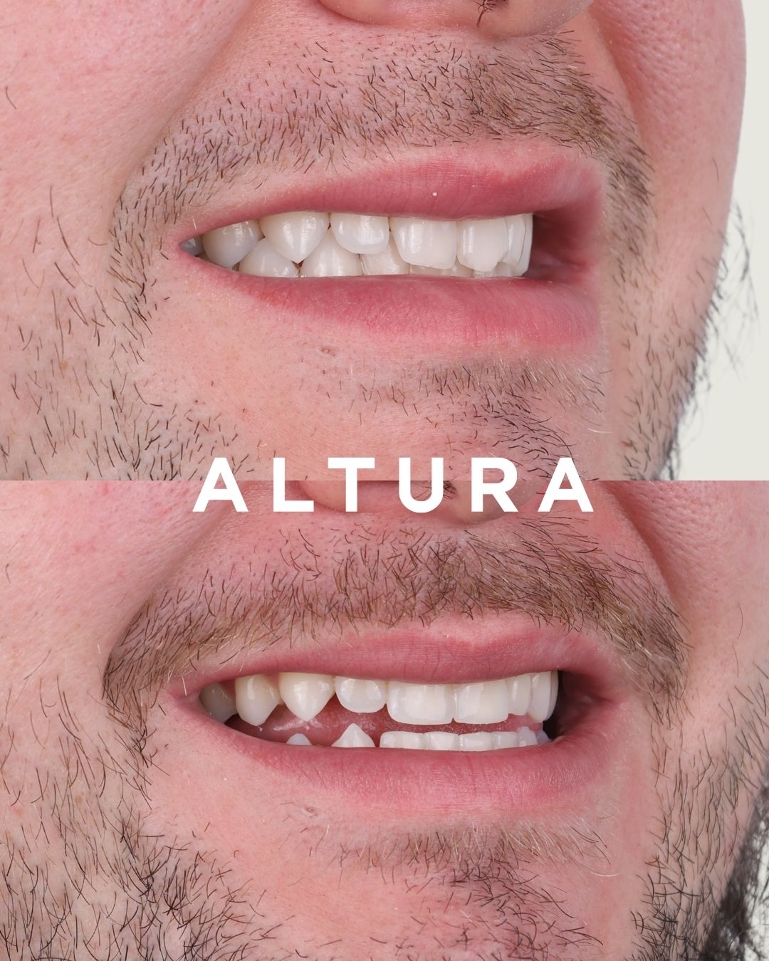 C-EB-AC-TEETH-AM-3