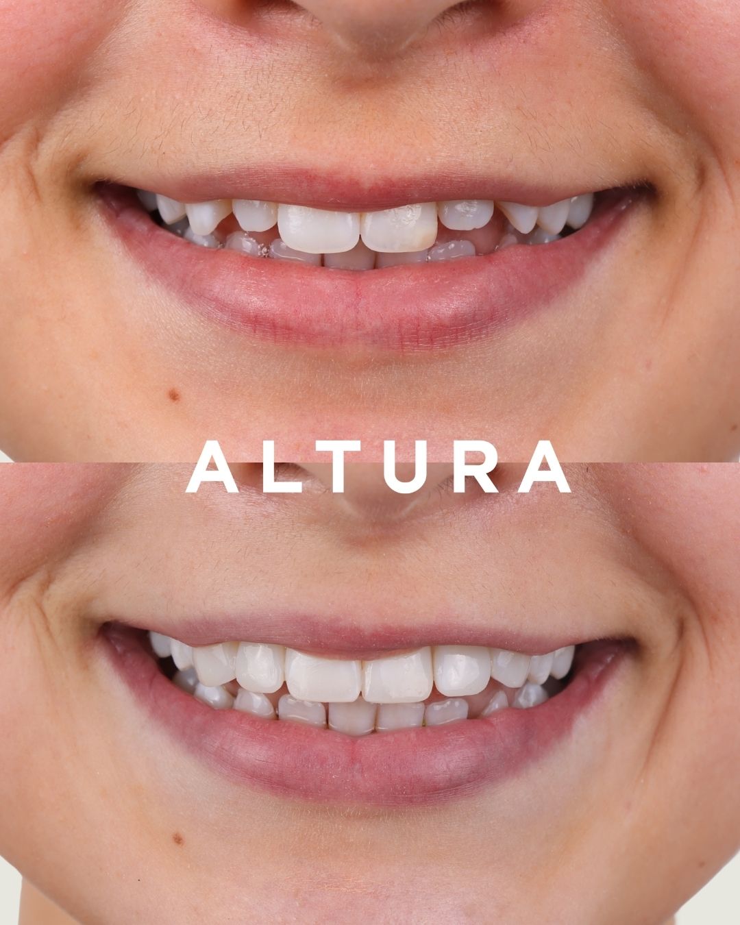 C-EB-CV-AC-TEETH-RJ-1