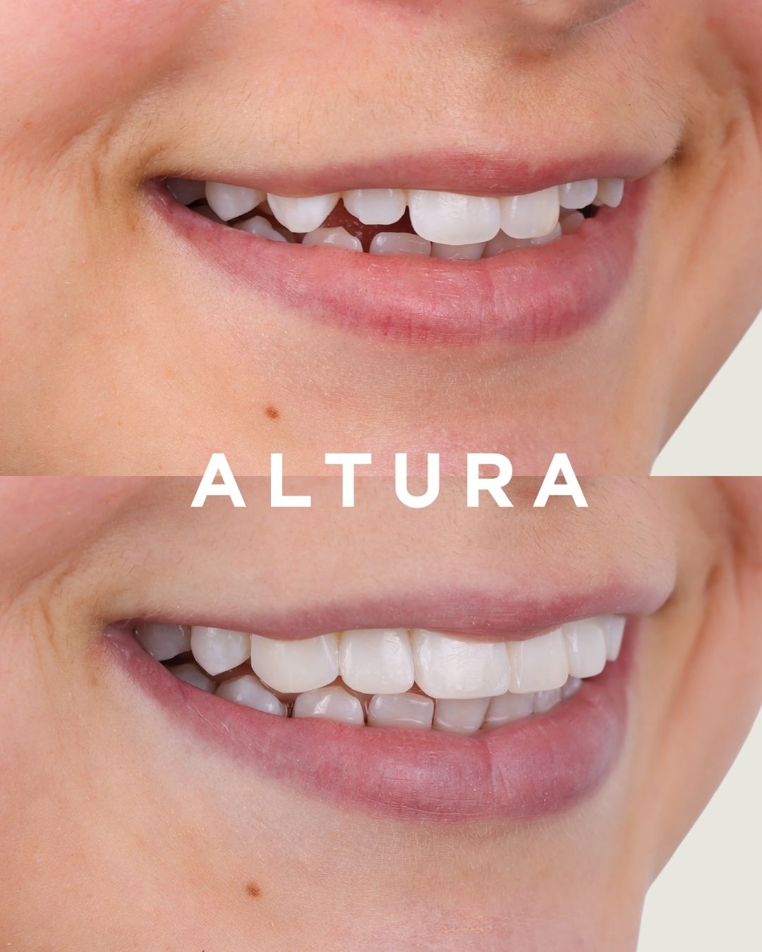 C-EB-CV-AC-TEETH-RJ-3