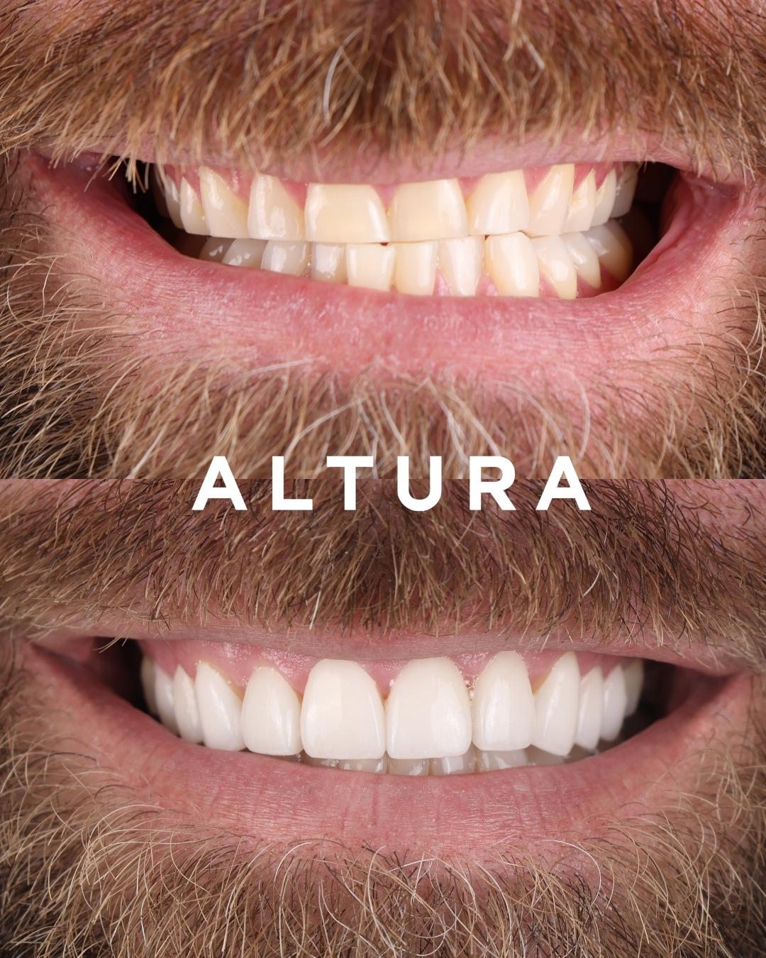 C-PV-AC-TEETH-DR-1