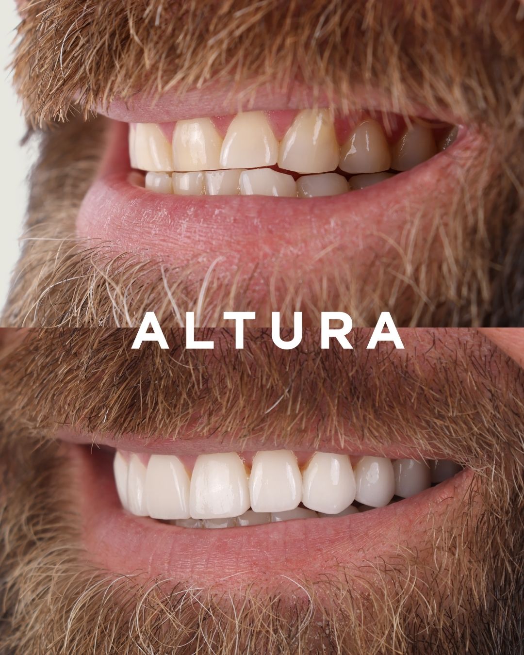 C-PV-AC-TEETH-DR-2