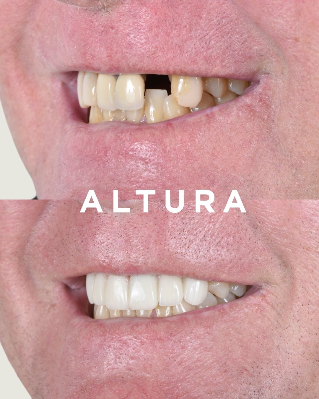 C-PV-AC-TEETH-JH-2