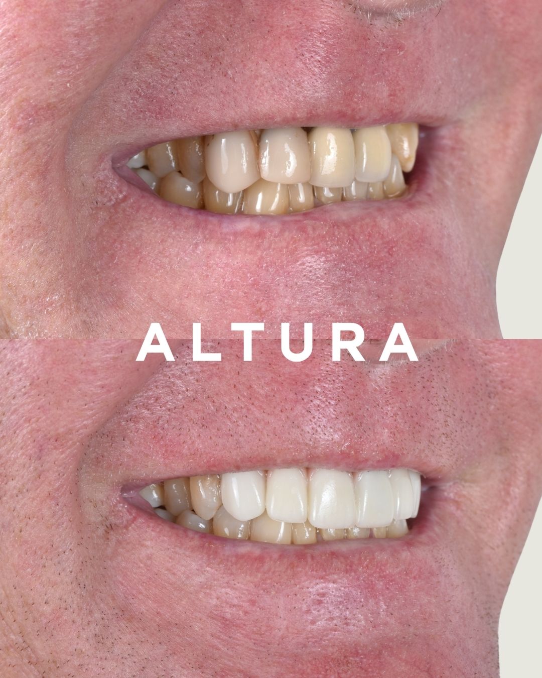 C-PV-AC-TEETH-JH-3