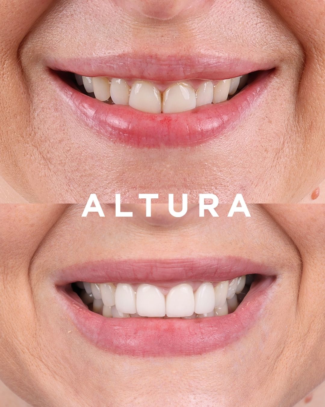 C-PV-AC-TEETH-KM-1
