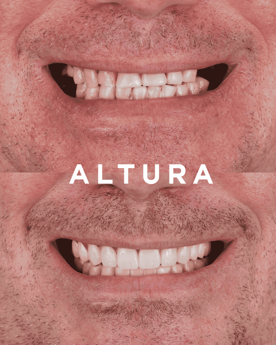 C-CR-AC-TEETH-AK-1