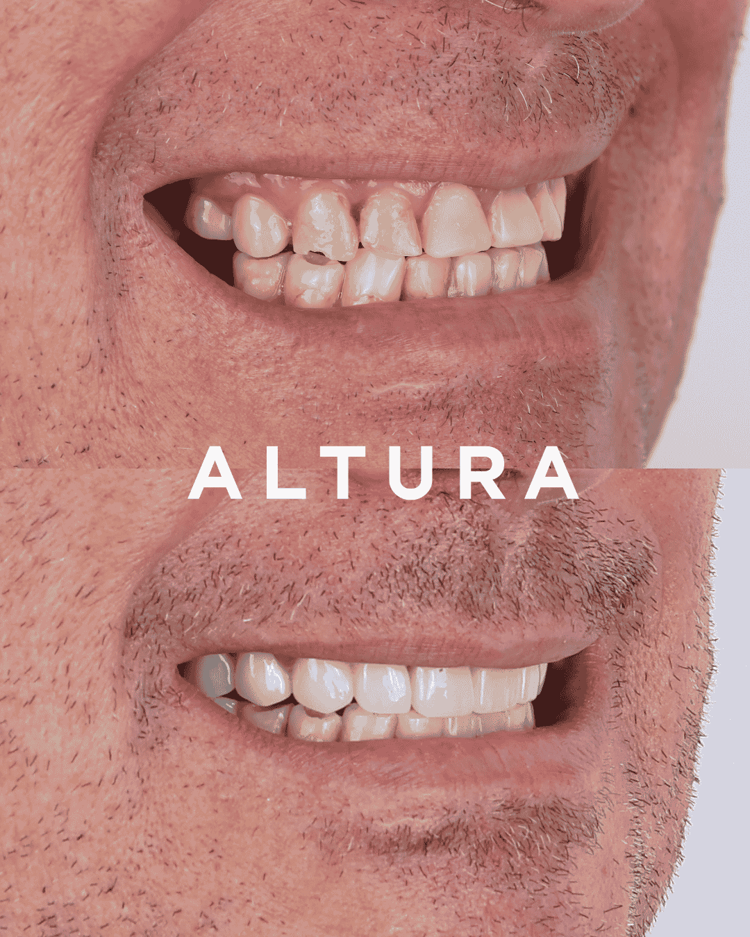C-CR-AC-TEETH-AK-3