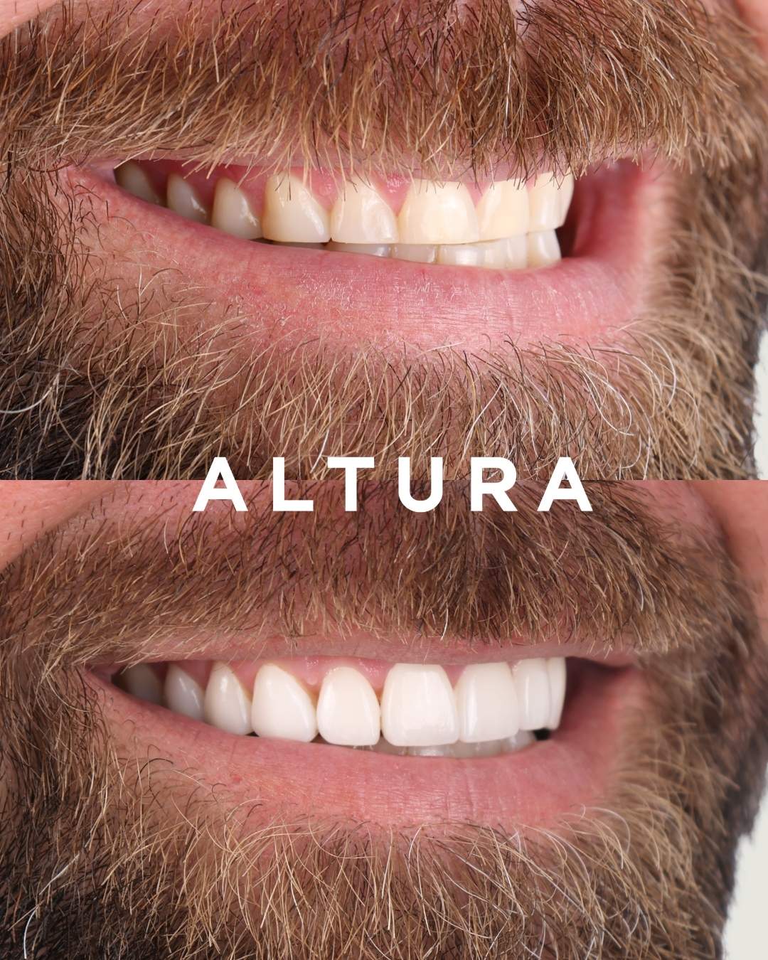 C-PV-AC-TEETH-DR-03