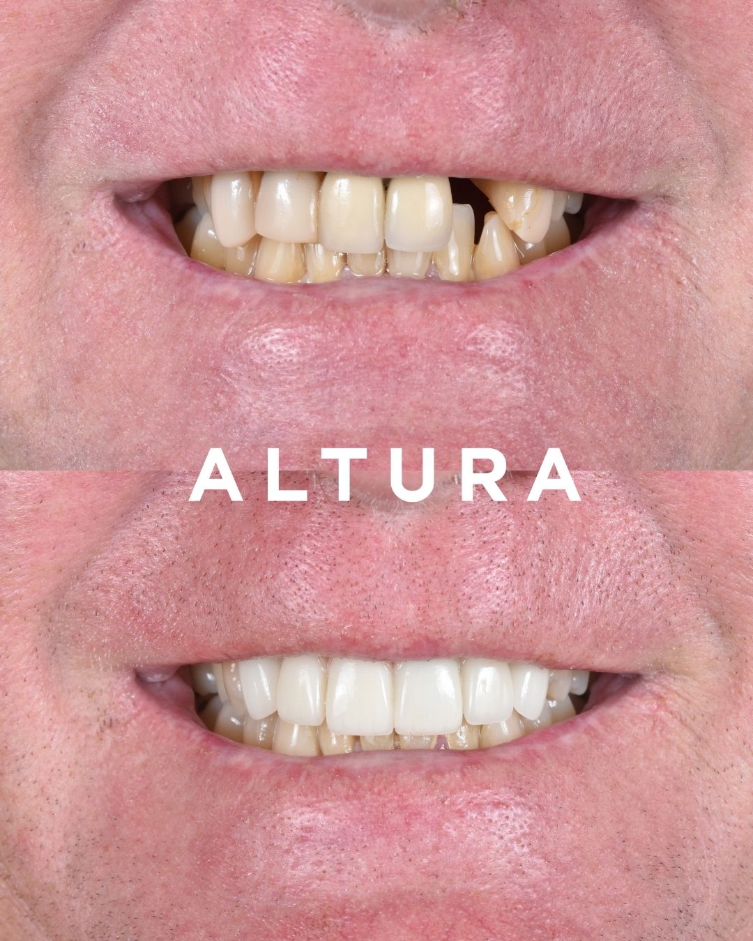 C-PV-AC-TEETH-JH-01