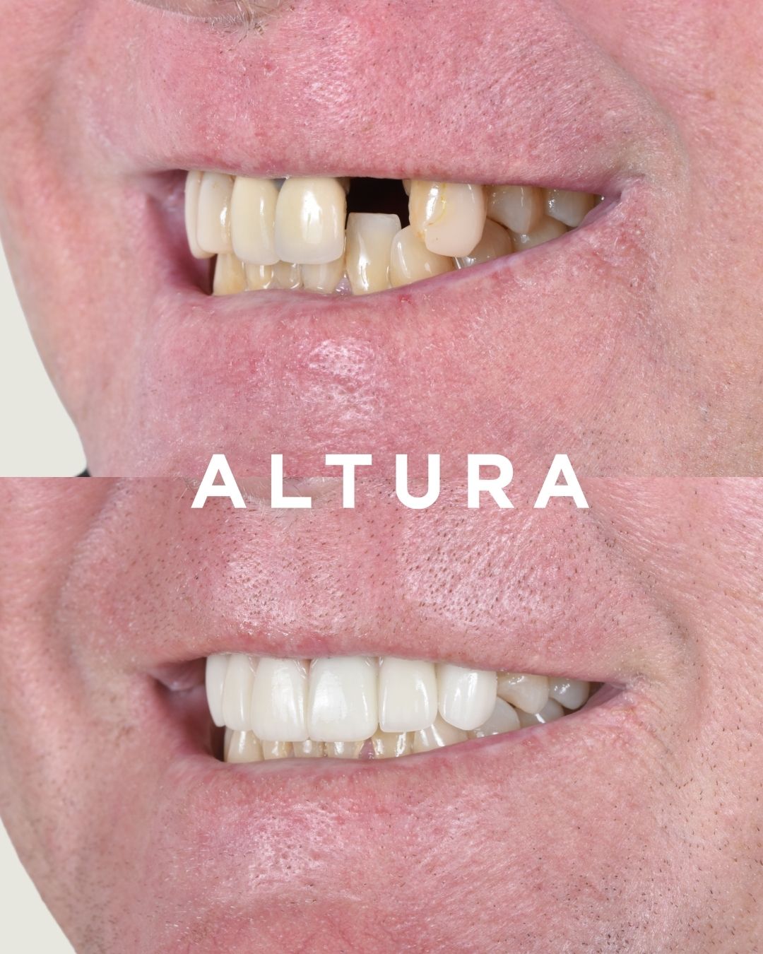C-PV-AC-TEETH-JH-02