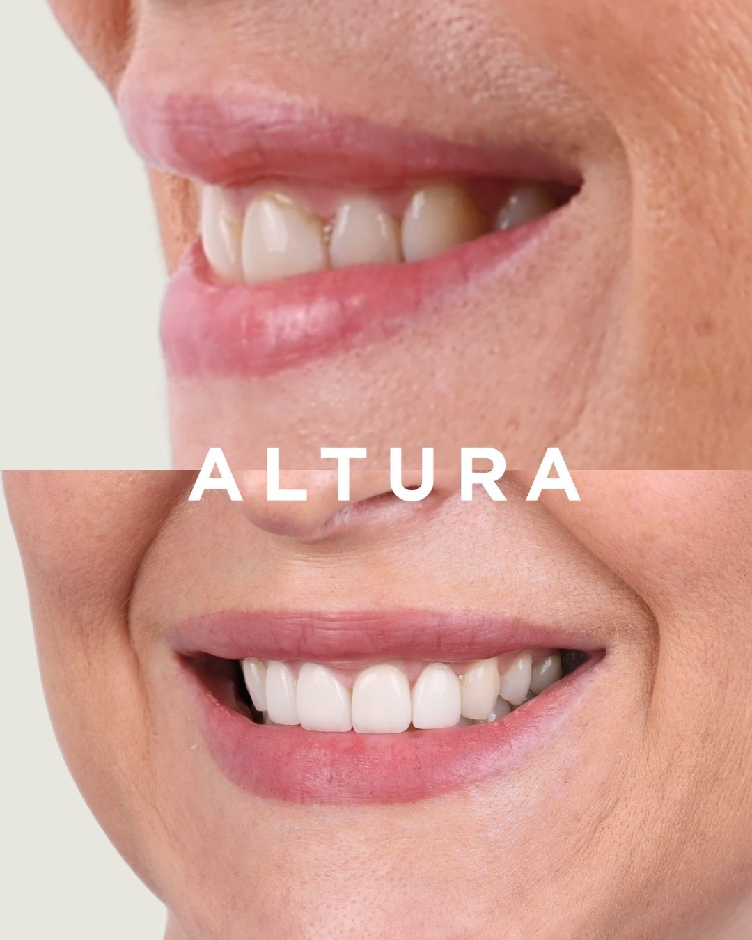 C-PV-AC-TEETH-KM-02