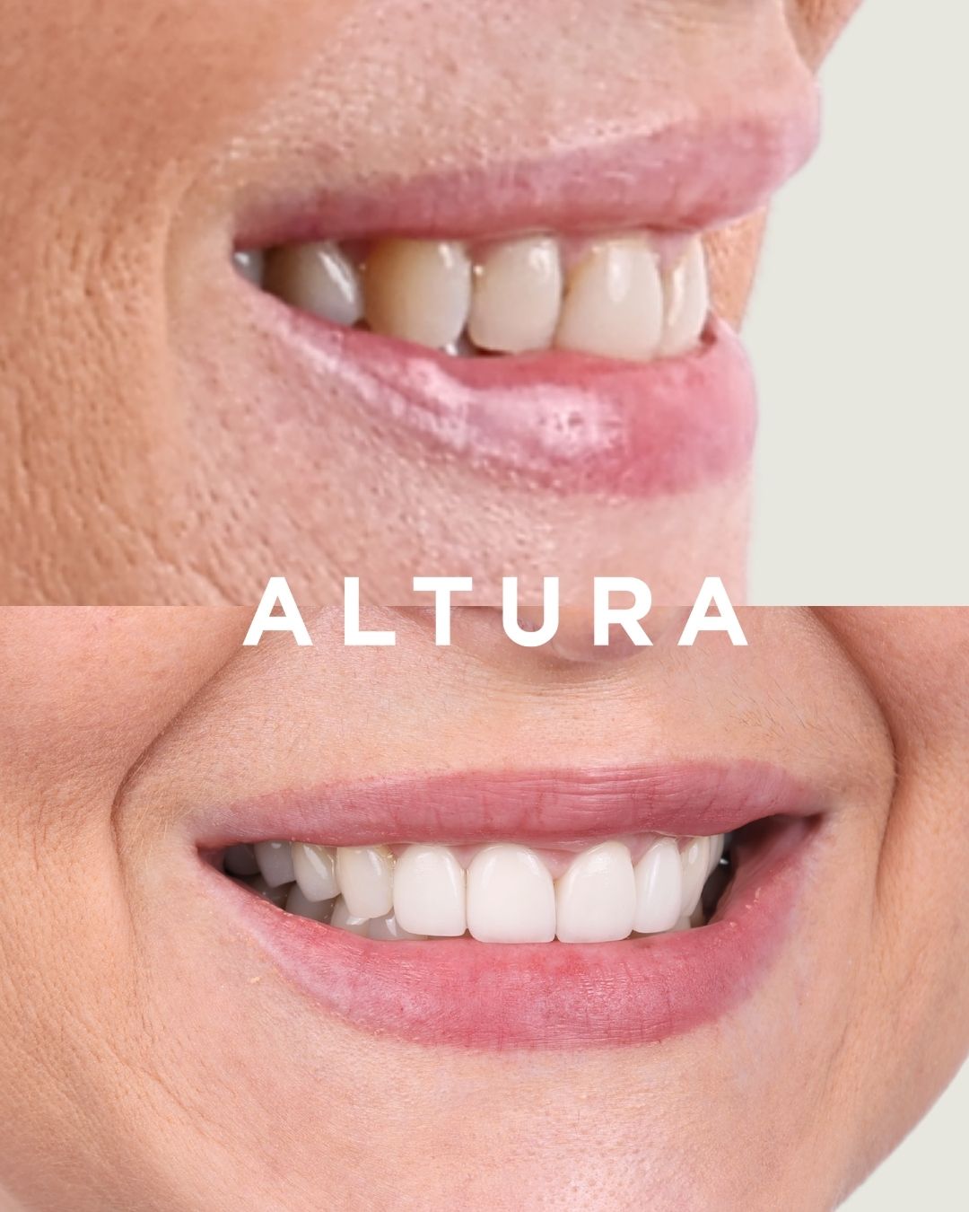 C-PV-AC-TEETH-KM-03